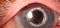Argus II, a bionic eye to wipe out blindness Image 2