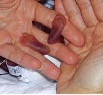 Ten Ounce Baby Survives