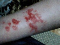 Blood-Sucking Infestations Image 6