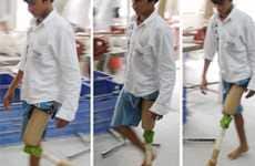 Prosthetics for the Poor