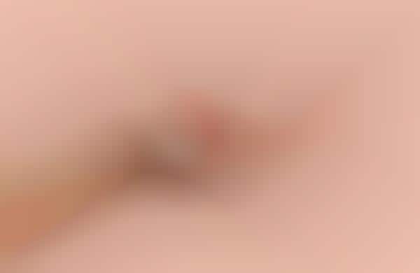Microdart Acne Patches