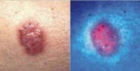 Light Bandages to Cure Cancer Image 3