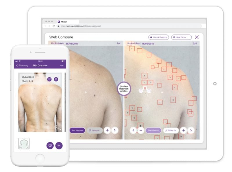 AI-Powered Mole Mapping Apps