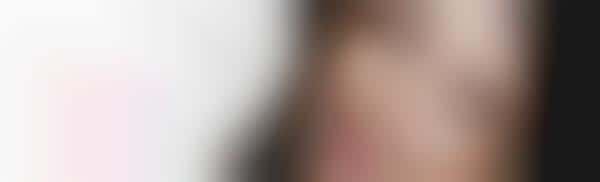 Hyperpigmentation-Specific Skincare