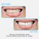 Dosed Teeth-Whitening Kits Image 3