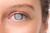 Cataract-Clearing Treatments Image 1