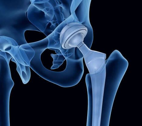 Ultra-Flexible Hip Implant Materials