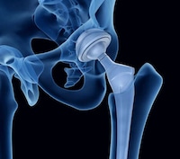 Ultra-Flexible Hip Implant Materials Image 1