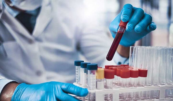 Neurodegenerative Disease Tests