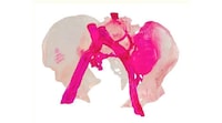 3D-Printed Pelvic Implants Image 1