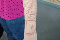 Creative Scar Cover Ups Image 2