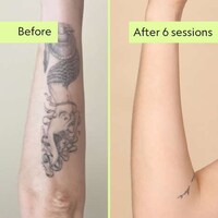 Gentle Tattoo Removal Services Image 4