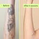 Gentle Tattoo Removal Services Image 4