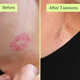 Gentle Tattoo Removal Services Image 5