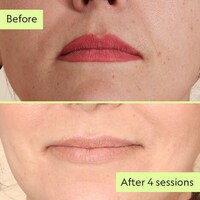 Gentle Tattoo Removal Services Image 6