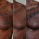 Gentle Tattoo Removal Services Image 7