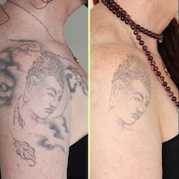 Gentle Tattoo Removal Services Image 8