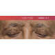 Eyelid Health Campaigns Image 1