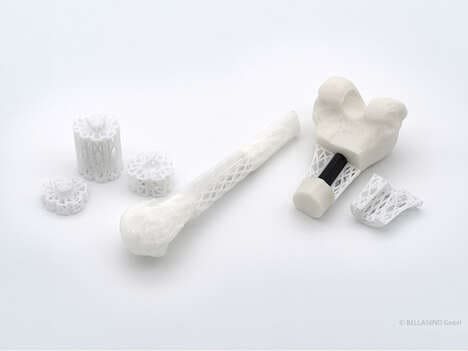 3D-Printed Bone Implants