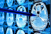 AI Cancer Detection Tools