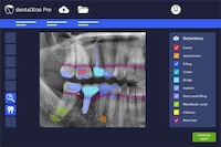 AI-Based Dental Analysis Programs Image 1