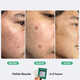 Fast Acting Acne Kits Image 2
