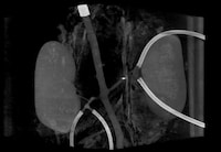 Blood Clot-Relieving Millirobots Image 2