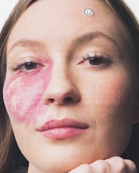 Biomimetic Pimple Patches Image 3