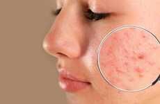 Korean Skincare For Acne