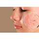 Korean Skincare For Acne Image 1