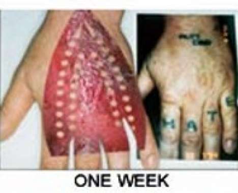 10 Anatomical Removals