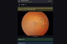 AI Eye Screening