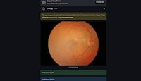 AI Eye Screening Image 1