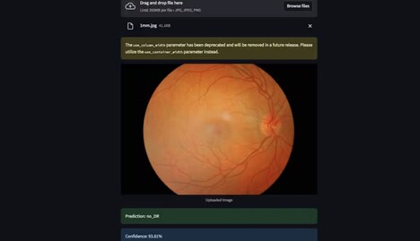 AI Eye Screening