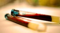 Early Parkinson&rsquo;s Blood Biomarkers