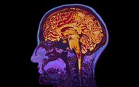 AI MRI Readers