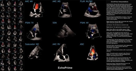 Video-Based Cardiac AI Tools