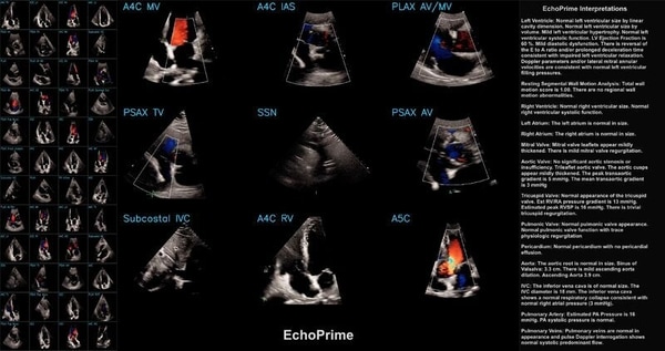 Video-Based Cardiac AI Tools