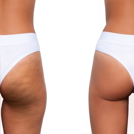 Biotech Body Sculpting