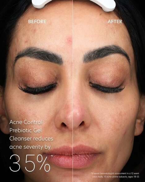 Microbiome-Supporting Acne Cleansers