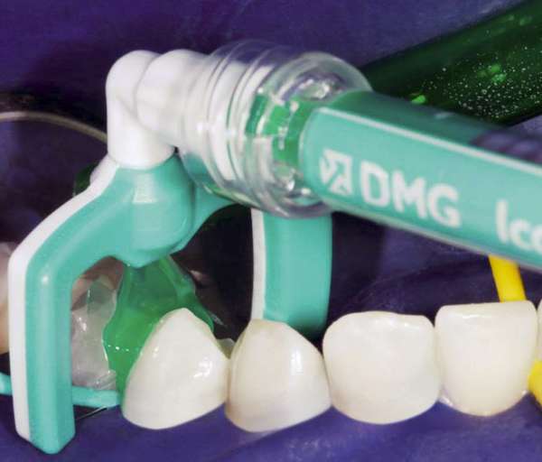Painless Cavity Fighters