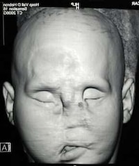 Face Transplants Image 2
