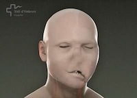 Face Transplants Image 5