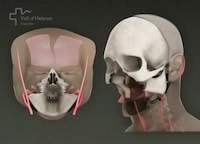 Face Transplants Image 6