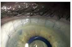 Telescopic Eyeball Implants