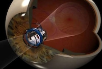 Telescopic Eyeball Implants Image 2