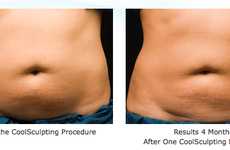 Fat-Freezing Technologies