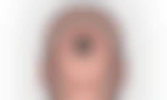 Camera Head Implants