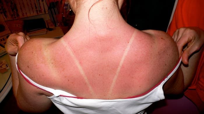 Color-Changing Sunburn Sensors