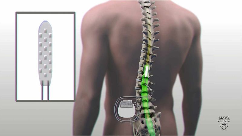 Spinal Injury Repair Implants